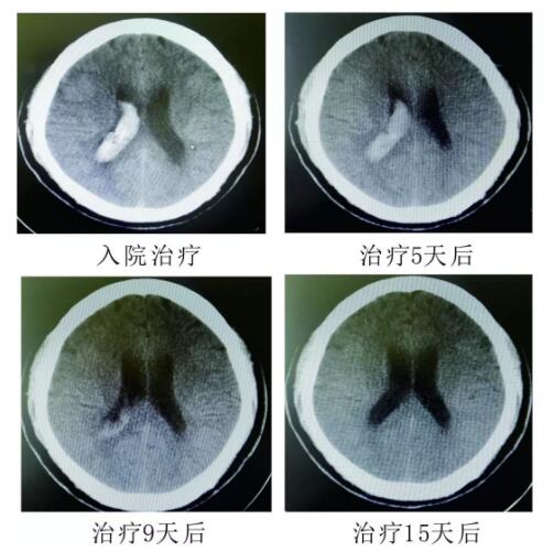腦出血你不得不引起重視的疾病?。。?></a></div>
               
 					<div   id=