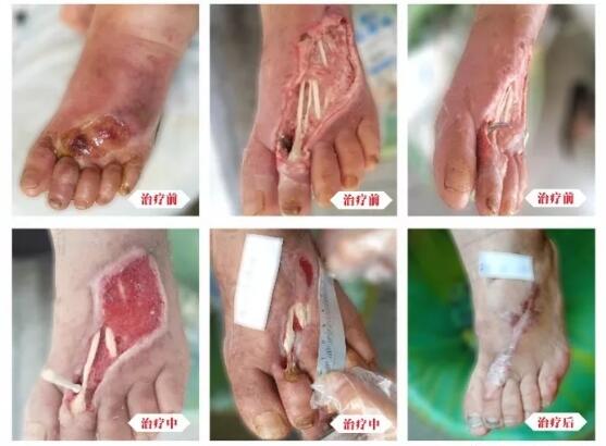 糖尿病并發(fā)癥有多可怕，及時治療糖尿病足避免截肢！