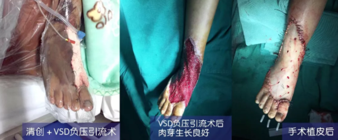車(chē)禍猛如虎，救治如“華佗” ，手術(shù)＋康復(fù)，8歲小女孩車(chē)禍后日漸康復(fù)行走