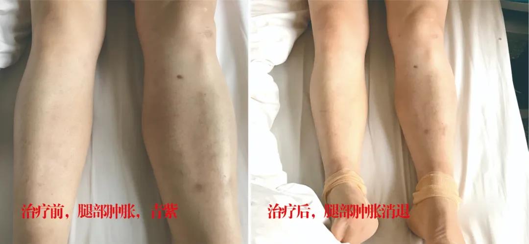 下肢靜脈血栓多年頑疾反復(fù)腫痛——疾病不容等待，早治療，早健康！