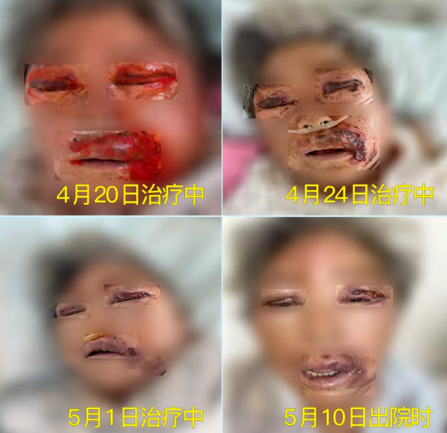 膿毒血癥（急性頜面部蜂窩組織炎）多學(xué)科聯(lián)合會(huì)診，幫助患者成功治愈！