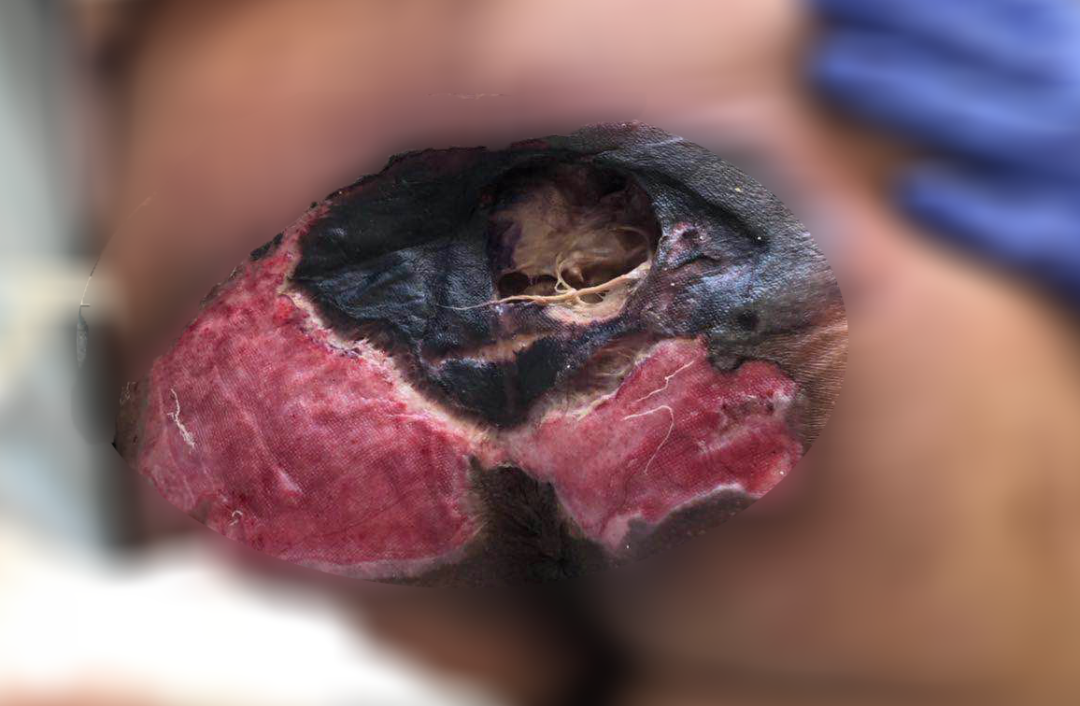 癱瘓3年的女患者臀部居然變成這樣?！