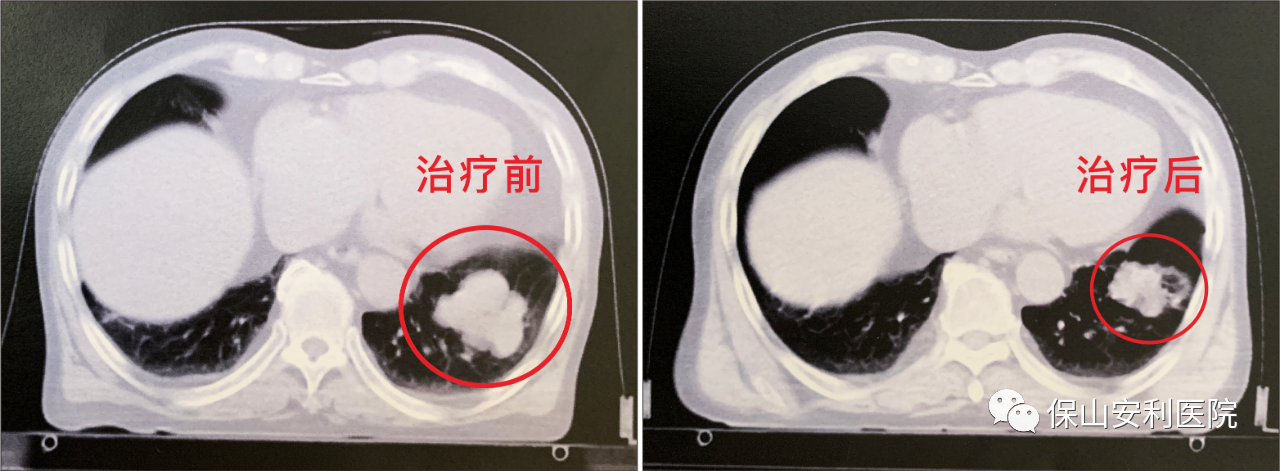 不做手術(shù)，早期肺癌也能根治！