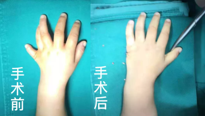 【保山安利醫(yī)院】2歲小兒手、足多指（趾）成功修復(fù)(矯正）！