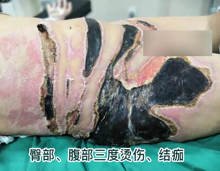 【保山安利醫(yī)院】80歲老人不慎燒傷，導(dǎo)致腹部、右側(cè)臀部大面積創(chuàng)傷，經(jīng)植皮治療創(chuàng)面逐漸愈合