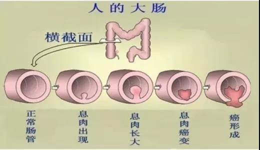 體檢發(fā)現(xiàn)腸息肉會癌變嗎？