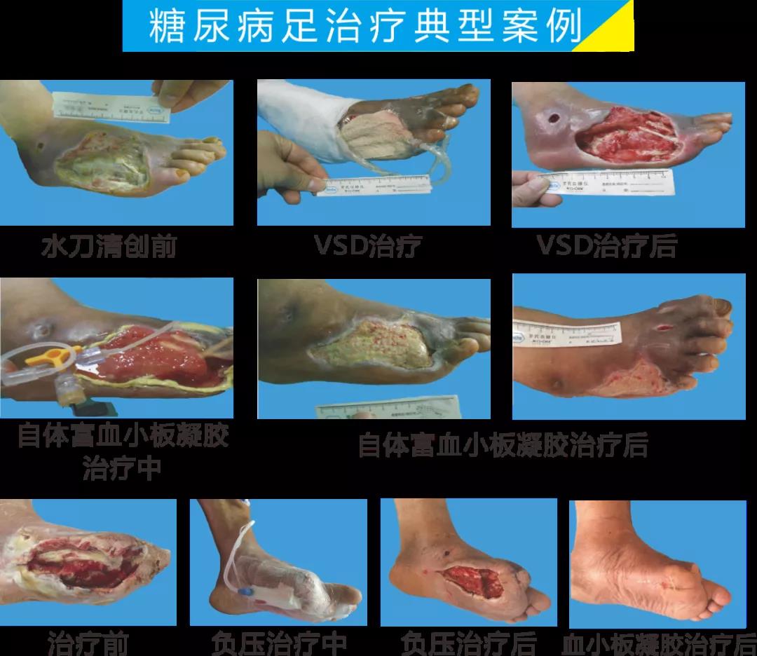 截肢、失明，甚至……，我們要做的是將糖尿病并發(fā)癥遏制在搖籃里！