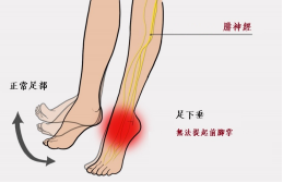 【保山安利醫(yī)院—健康科普】什么是足下垂！你了解嗎？
