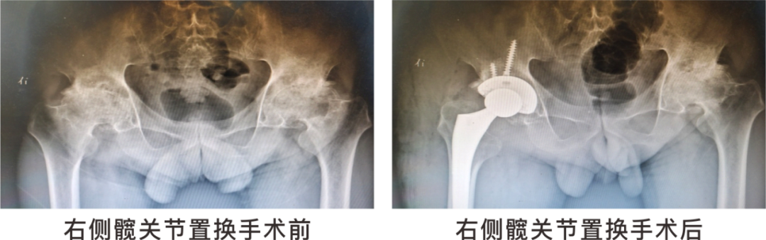 【保山安利醫(yī)院】長(zhǎng)期飲酒導(dǎo)致雙側(cè)股骨頭壞死，髖關(guān)節(jié)置換后重獲運(yùn)動(dòng)功能！
