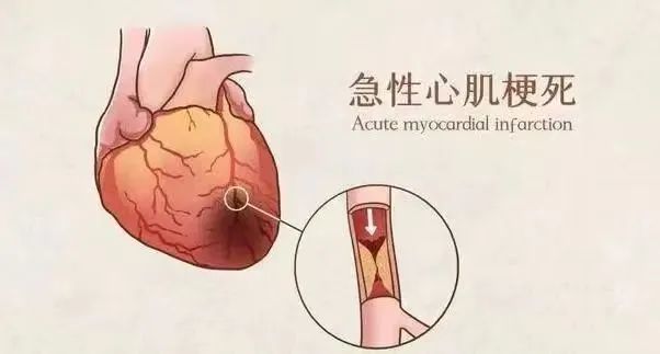 【保山安利醫(yī)院】11月20日“心梗救治日” 時間就是心肌，時間就是生命！