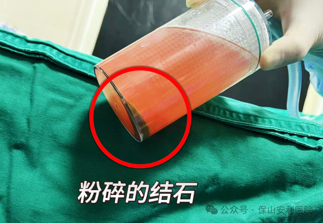 科普丨泌尿結(jié)石“克星”鈥激光碎石術(shù)，手術(shù)動(dòng)圖揭秘全過(guò)程！